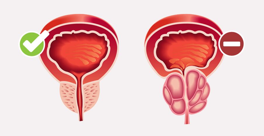 Weiprost normalizza le dimensioni e la funzione della prostata