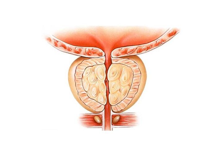 infiammazione della prostata