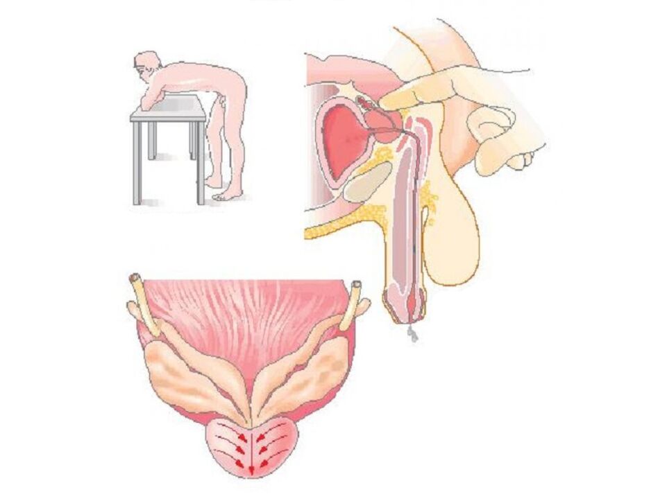 Tecnica di massaggio prostatico da parte di un medico per effettuare un'analisi della secrezione